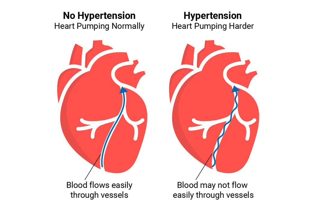 High Blood Pressure Guidelines